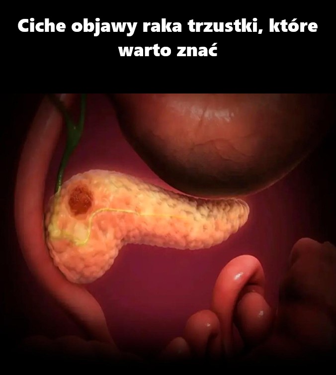 Ciche objawy raka trzustki, które warto znać