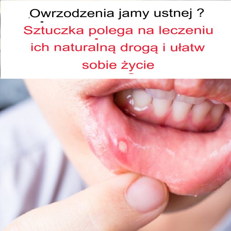 Afty w jamie ustnej: oto jak się ich naturalnie pozbyć w kilka minut bez użycia leków