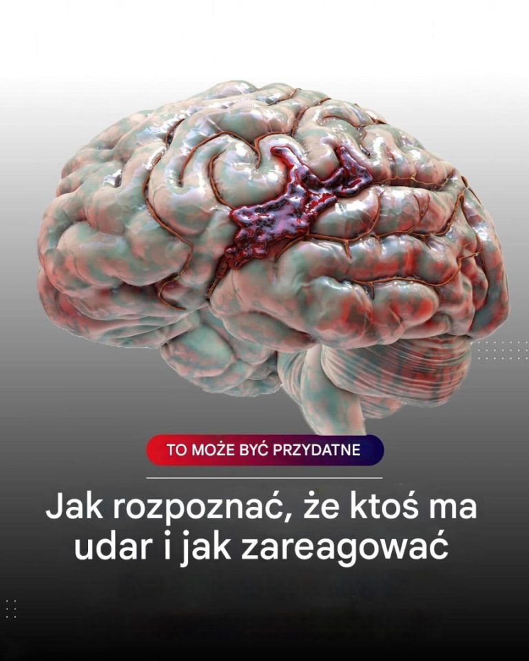 Udar mózgu często ma oczywiste objawy, ale w rzeczywistości wiele osób je ignoruje lub myli z mniej poważnymi schorzeniami.