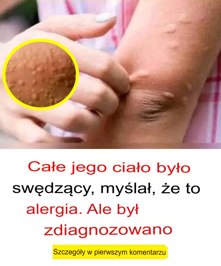 Całe ciało go swędziało, pomyślał, że to alergia i zdiagnozowano to