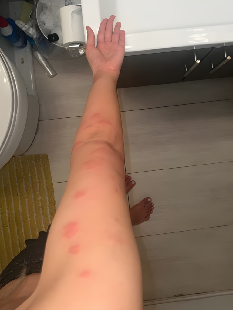 Ślady po ukąszeniach – jak rozpoznać 10 najczęstszych „gryzących” winowajców? Przewodnik wizualno-praktyczny