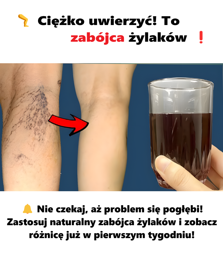 Ciężko uwierzyć! To zabójca żylaków! Szybko pozbądź się żylaków