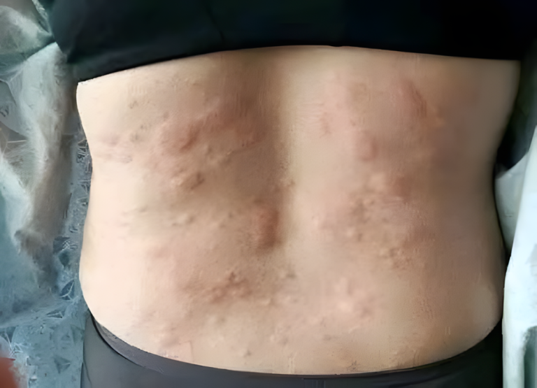 Pokrzywka? Alergia? Całe jej ciało swędziało, lekarze zdiagnozowali najgorsze