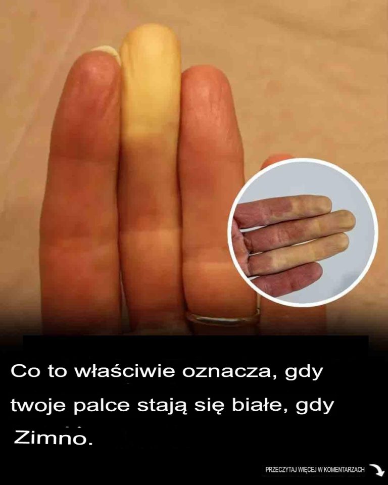 Co tak naprawdę oznacza, gdy jeden z palców robi się biały, gdy jest zimno