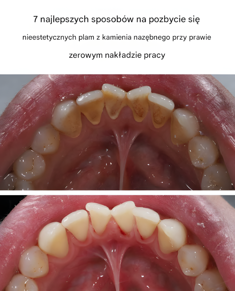 7 najlepszych sposobów na pozbycie się nieestetycznych plam z kamienia nazębnego przy prawie zerowym nakładzie pracy