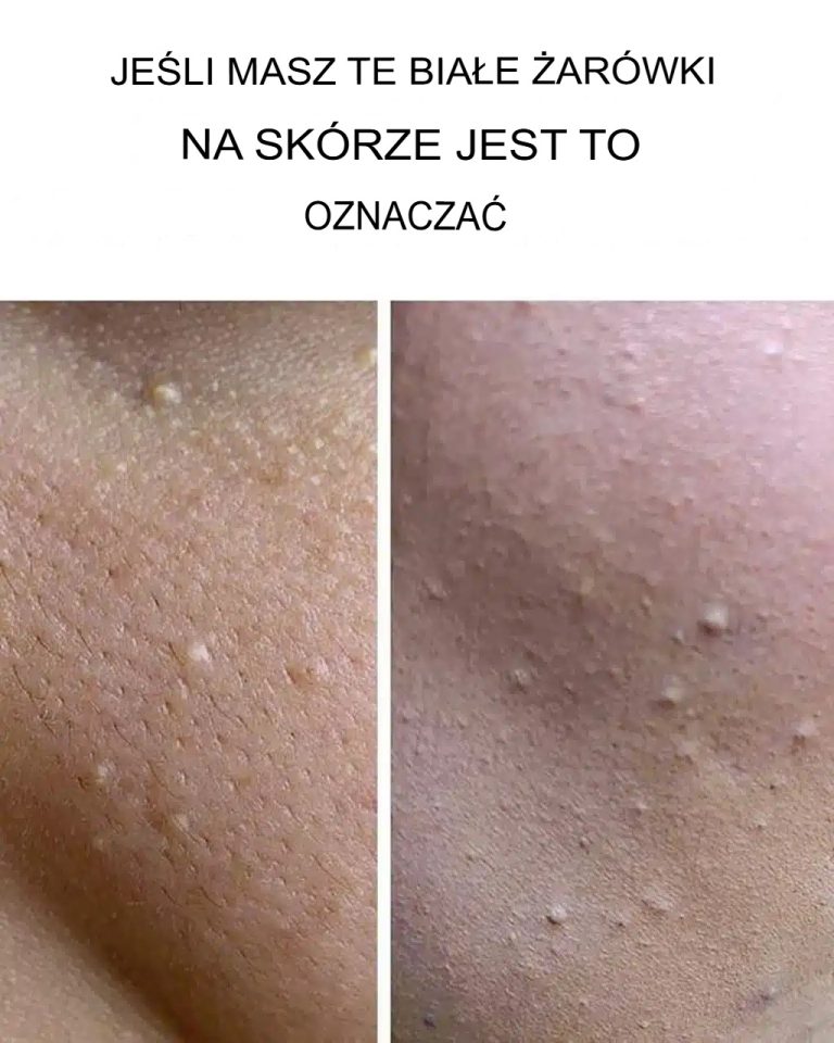 Białe kulki na skórze: co oznaczają?