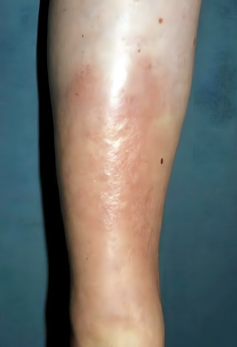 Pretibial Myxedema - Zdjęcia, Leczenie, Objawy, Przyczyny